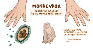 Monkeypox Explained