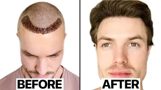 My Hair Transplant Results *6 Months* | Surgeon Reacts