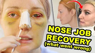 MY NOSE JOB | PART 2 | WHAT WENT WRONG & WHY I REGRET IT