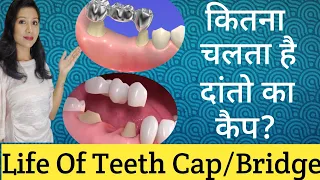 कितना चलता है दांतों का कैप |Life Of Teeth Cap/Bridge |कैप/ब्रिज लगाने के बाद क्या करें क्या ना करें