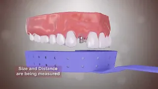 Dental Implants Procedure animation