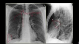 Tromboembolismo Pulmonar