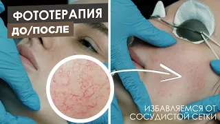 Фототерапия До и После | Лечение купероза на лице | Устранение сосудистой сетки