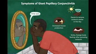 Giant papillary conjunctivitis #kanskiseries #2022