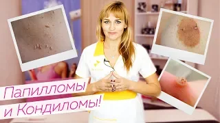 ШОК! Папилломы и Кондиломы - Как избавиться? / Можно ли делать шугаринг?