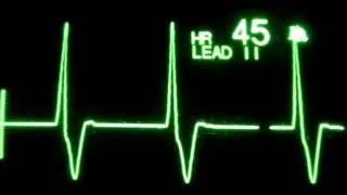 Accelerated Ventricular Rhythm (AVR)