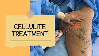 AVELI CUTS THE SEPTA OF CELLULITE FOR SMOOTH AND THICC THIGHS | Dr. Jason Emer