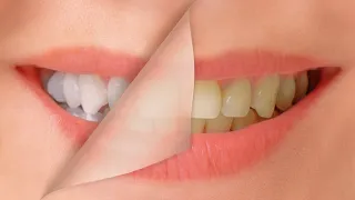 Top 3 Astonishing Best Teeth Whitening Kits For Vibrant Smile