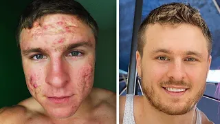 How I FINALLY Got Rid of My Acne!