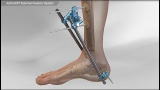 ArthroFX® External Fixation System