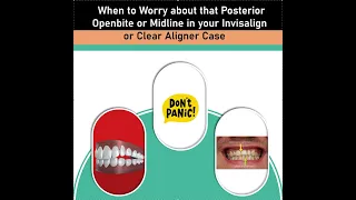 When to Address Midlines and POB (posterior openbite) in an Invisalign or CLearCorrect Case