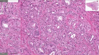 Prostatic Adenocarcinoma - Histopathology