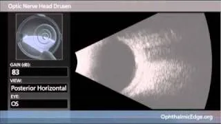 Optic Nerve Head Drusen
