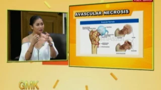 Usapang Pangkalusugan: Dr. Pebbles talks about Avascular Necrosis (Osteonecrosis)