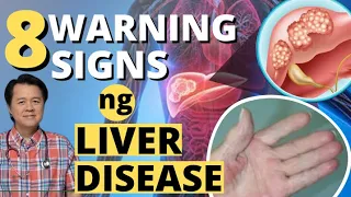 8 Warning Signs ng Liver Disease - Payo ni Doc Willie Ong #1344