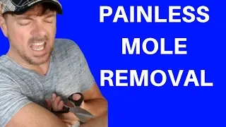 BEST WAY TO REMOVE MOLES | SKIN TAGS TOO! | Chris Gibson