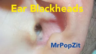 Ear Blackhead extractions.Deep in the ear blackheads.Quick extractions, one dry, one juicy. MrPopZit