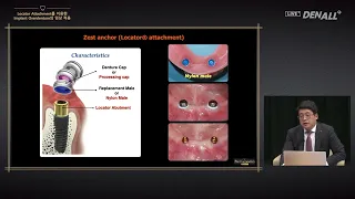 [PROSTHODONTICS] Clinical Application of Implant Overdenture Using Locator Attachment