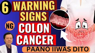 6 Warning Signs ng Colon Cancer. Paano Iiwas Dito - by Doc Willie Ong