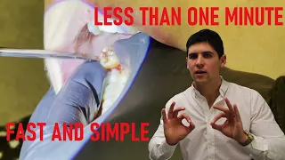 Wisdom tooth removal (extraction) in under one minute, with surprise at the end. No forceps needed