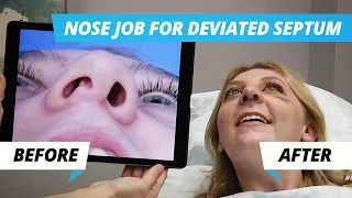 Nose Job Surgery for Deviated Septum – Rhinoplasty to Improve Crooked Nose