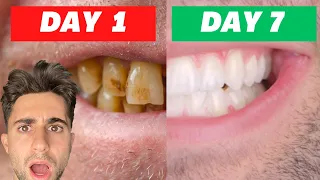 I Tried Crest Whitening Strips For 7 Days| INSANE RESULTS (Honest Review)