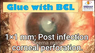 Tips for Glue and BCL for Corneal perforation by Dr Seema Mane