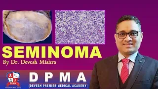 SEMINOMA  Pathology by Dr. Devesh Mishra