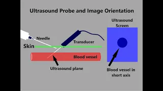 Vascular access with ultrasound