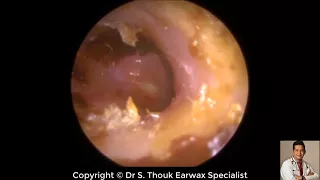 Top Biggest Ear Wax Removal #113 | Ear wax Extraction | Dr. S. Thouk Earwax Specialist