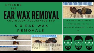 5 X EAR WAX REMOVALS - EP 361