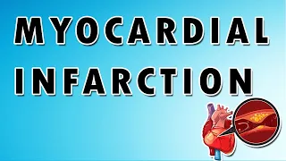 Myocardial infarction treatment - Mnemonics