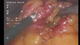 Laparoscopic Subtotal Pancreatectomy with En Block Splenectomy
