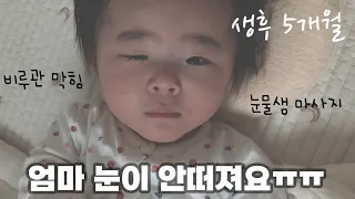 ENG) 5개월아기 여전히 비루관이 막혔어요/ 눈꼽 많이 끼는 아기엄마들은 보세요/ 눈물샘 뚫기 /눈물샘 마사지 /