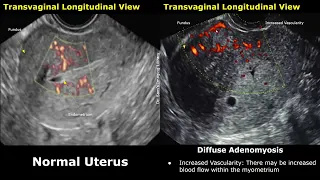 Uterus Ultrasound Normal Vs Adenomyosis Images | Diffuse & Focal Types | Gynecological USG Scan