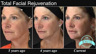 60 yo Female Facial Rejuvenation - A Refreshed Face | Aesthetic Minutes #Facelift #Blepharoplasty