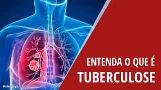 Entenda o que é Tuberculose | Sua Saúde na Rede