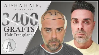 Maximum Hairline Density With Hair Transplant | Línea Frontal Máxima Densidad Con Injerto Capilar