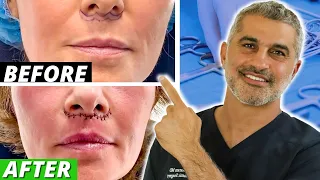 Entire Lip lift Procedure from Start to Finish (beautiful after result)