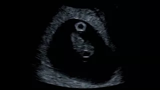 What Can You See At An 8 Week Baby Scan?