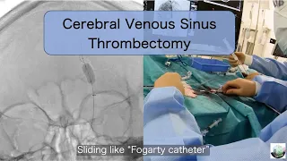 Cerebral venous sinus thrombosis, Endovascular mechanical thrombectomy