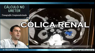 CÁLCULO RENAL: Avaliação por Tomografia Computadorizada  #cálculorenal #nefrolitíase