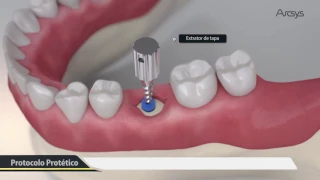 Procedimento Cirúrgico 3D - Arcsys Sistema de Implantes | FGM