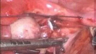 0 davidov vaginoplasty 05