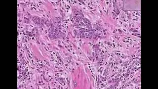 Histopathology Prostate--Adenocarcinoma (Gleason grade 5)