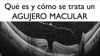 ¿Qué es y cómo se trata un agujero macular? - Dr. Gerardo García Aguirre - Retina