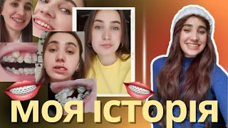 Історія моїх зубів | Брекети | Зуби мудрості  | до та після