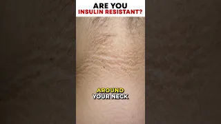 Are you Insulin Resistant? | SugarMD