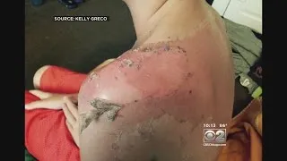 2 Investigators: Boy Gets Second-Degree Sunburn From Summer Camp