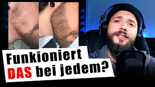 Bei wem funktioniert Minoxidil für den Bart?